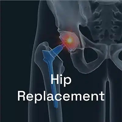 Illustration of a hip replacement procedure