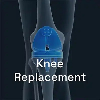 Graphic of a knee replacement