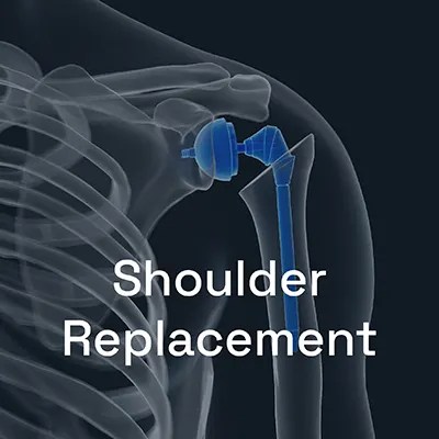 Illustration of a shoulder replacement surgery